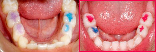 leczenie zębów dzieci